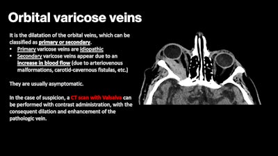 A 94-year-old woman underwent CT following a traumatic brain injury. The CT scan shows a superoexternal orbital mass, suggestive of orbital varix.