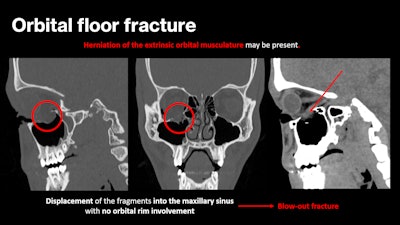 A 20-year-old patient who came to the emergency department following an assault. The CT scan shows a blowout fracture of the orbital floor (circle) with herniation and entrapment of the inferior rectus muscle (arrow).