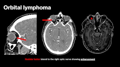 An 85-year-old patient with suspected carotid cavernous fistula due to conjunctival hyperemia that evolved over nine months. The CT scan shows a 4-mm lateral nodular thickening in contact with the posterior wall of the eyeball, lateral to the optic nerve. This lesion shows enhancement after contrast administration (arrows on CT scan, and arrowhead on T1-weighted gadolinium-enhanced MRI).