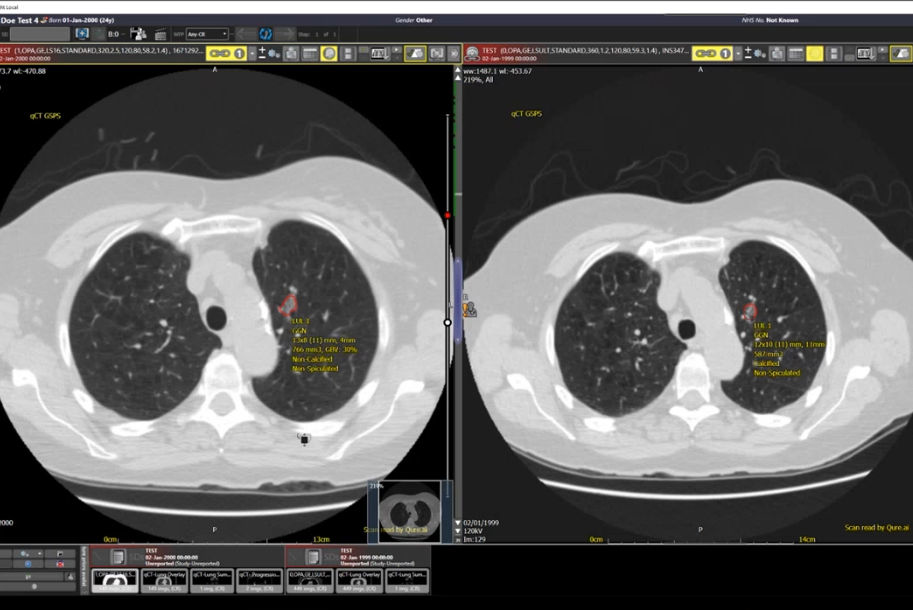 2025 04 15 Q Ct Chest Ct Ai Thumbnail