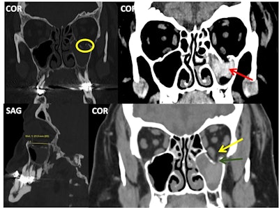 Pure and simple blow-out left orbital fracture; the orbital rim and internal orbital buttress remain unaltered. Over half of the orbital floor is involved (measurement in the lower left image), and the fracture line crosses the infraorbital canal (yellow circle). The left inferior rectus muscle (yellow arrow) looks asymmetrical when compared to the contralateral one and appears to be “tractioned” with accompanying intraorbital fibrofatty tissue into the left maxillary sinus (dark green arrow); the sinus also has hyperdense content compatible with a hematoma (red arrow).