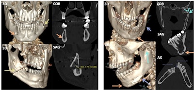 The images on the left side of the vertical white bar show a bilateral mandibular fracture. The left fracture (light yellowish-brown arrows) is located in the mandibular angle and crosses the mandibular canal, causing a fragment displacement of more than 5 mm (measurement in lower right image). The nondisplaced right fracture (orange arrows) is subtle in the parasymphyseal region, but it appears to involve the mental foramen. The images on the right side of the vertical white bar illustrate a bifocal left mandibular fracture. A comminuted and displaced (lower right image) fracture involves the symphyseal and parasymphyseal regions (orange arrows) and the mandibular body (lavender arrows) and crosses the mental foramen of the mandibular canal. The other fracture is a subcondylar luxation fracture (light blue arrows) with >35º angled fragments (light blue angle).