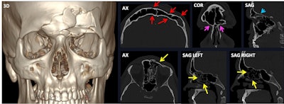 Bilateral frontal fracture involving both the anterior and posterior wall of both frontal sinuses (3D and red arrows). The fracture spreads inferiorly to both superior orbital rims (magenta arrows), posteriorly towards the anterior cranial fossa, with a resulting pneumocephalus bubble (blue arrow), and medially (yellow arrow in the axial view). Nevertheless, both frontonasal ducts remain intact (yellow arrows in sagittal views). AX = axial view, COR = coronal view, SAG = sagittal view, 3D = volume-rendered reconstruction. All figures courtesy of Dr. Mónica Régil Guerrero et al and presented at ECR 2025.