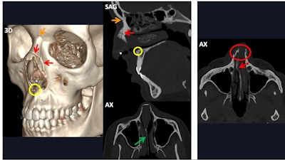 The images on the left side of the white vertical bar show a bilateral, simple, and nondisplaced nasal fracture. The nasofrontal suture (orange arrows), nasal septum (green arrow), and anterior nasal spine (yellow circles) remain intact, while the fracture line crosses the left nasomaxillary suture (red arrows). On the other hand, the image on the right contains a bilateral, comminuted, and displaced nasoseptal fracture (red circle), in which the nasal septum is also involved (red arrow).