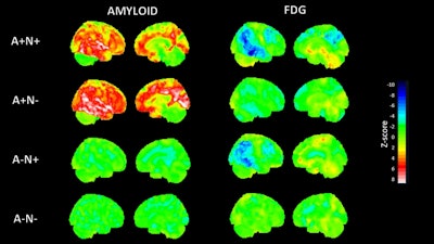 Representative Z-score maps derived from amyloid-PET and FDG-PET imaging across four biomarker-defined AT(N) groups: amyloid-PET positive/FDG-PET positive (A + N+), amyloid-PET positive/FDG-PET negative (A + N–), amyloid-PET negative/FDG-PET positive (A–N+), and amyloid-PET negative/FDG-PET negative (A–N–). Sagittal brain views show cortical amyloid burden (left column) and glucose hypometabolism (right column). Z-scores were computed using a normative database of cognitively unimpaired individuals. Increased amyloid uptake (Z > 2) is shown in red-white hues, while reduced FDG uptake (Z < − 2) is represented in blue. All images were spatially normalized to MNI space and visualized using a standard intensity scale. Image and caption available for republishing under Creative Commons license (CC BY 4.0 DEED, Attribution 4.0 International) and courtesy of the European Journal of Nuclear Medicine and Molecular Imaging.