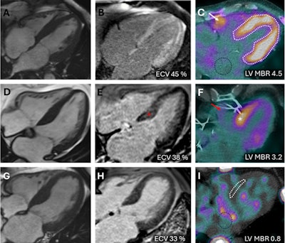 Typical transthyretin amyloidosis cardiomyopathy (ATTR), early detected ATTR, and a non-ATTR on cardiac MRI and SPECT/CT. Four-chamber cardiac MRI cine image (A), typical diffuse late gadolinium enhancement on cardiac MRI (B), and positive SPECT/CT (C) in a typical ATTR cardiomyopathy patient. The white outline denotes the whole left ventricular (LV) volume of interest (VOI) to obtain maximum myocardial standardized uptake value (SUVmax). Black and yellow circles demonstrate left and right atrial blood pool regions of interest. Four-chamber cardiac MRI cine image (D), nontypical septal predominant late gadolinium enhancement on cardiac MRI (E), and septal SPECT/CT uptake in a patient with early detected ATTR (white asterisk). The red arrow points to a minor right ventricular signal. Negative control patient on cardiac MRI (G and H) and SPECT/CT (I). The white line denotes the LV region of interest in SPECT/CT-negative patient. ECV = extracellular volume; LV MBR = left ventricular myocardium-to-blood ratio. Image and caption available for republishing under Creative Commons license (CC BY 4.0 DEED, Attribution 4.0 International) and courtesy of the Journal of Nuclear Cardiology.