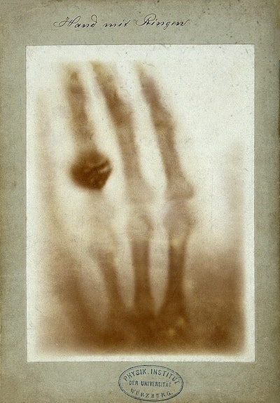The first medical x-ray. Image available for republishing under Creative Commons license (CC BY-NC 4.0, Attribution-NonCommercial 4.0 International and courtesy of the Wellcome Collection.