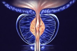 Benign Prostatic Hyperplasia 400