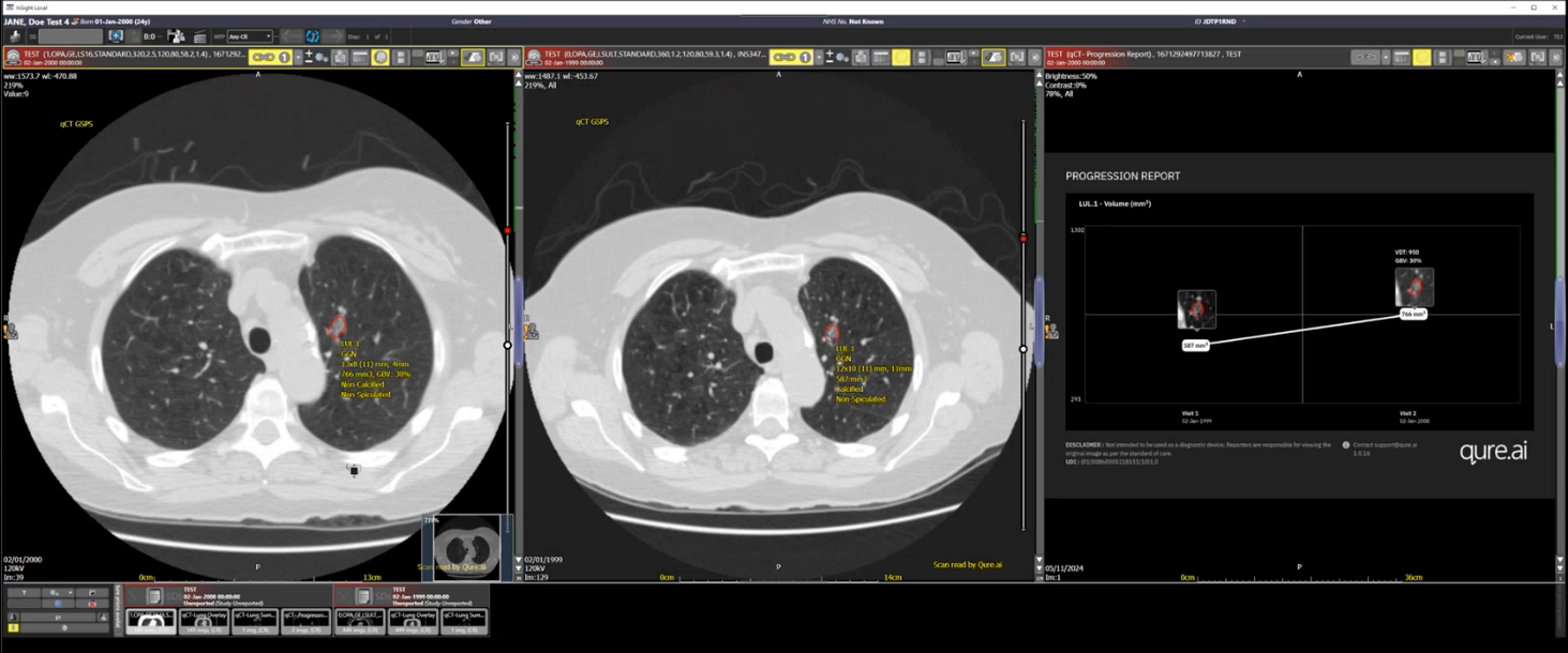 U.K. group goes live with Qure.ai chest CT program | AuntMinnieEurope