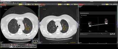 qCT shows nodule development over two timestamps – pulling a prior image and comparing the nodule found across different time periods.