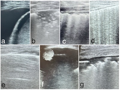 Images show lung ultrasound findings of major pleuro-pulmonary pathologies. (a) Pleural effusion; (b) Pneumonia; (c) Bronchopneumonia; (d) Acute pulmonary edema; (e) Chronic obstructive pulmonary disease exacerbation; (f) Pleuropulmonary tumors; (g) Acute respiratory distress syndrome.