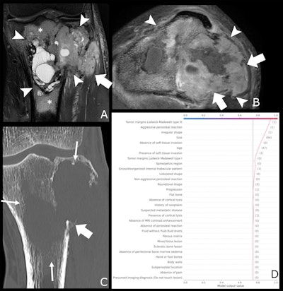 A 47-year-old male patient with knee pain for 10 months. (A) Coronal T2-weighted fat-saturated and (B) axial T1-weighted fat-saturated post-gadolinium MRI scans show a lytic lesion of the proximal tibia with an irregular shape (arrowheads), soft tissue invasion (fat arrow in A), and perilesional bone marrow edema (*). (C) Coronal CT image reconstructed with bone kernels of the same lesion show permeative margins (arrows) and a discontinuous periosteal reaction (fat arrow). (D) Shapley additive explanations decision function graph shows the impact of lesion characteristics on the ensemble classifier’s prediction. After a one-hot encoding for categorical features, present features are represented as '(1)' and absent features as '(0),' whereas continuous features are represented by the actual measurement. The estimated malignancy probability of this lesion was 0.94, which corresponds to Bone Tumor Imaging Reporting and Data System grade V. This lesion corresponded to an undifferentiated sarcoma at histologic examination and was graded as aggressive by the human reader.