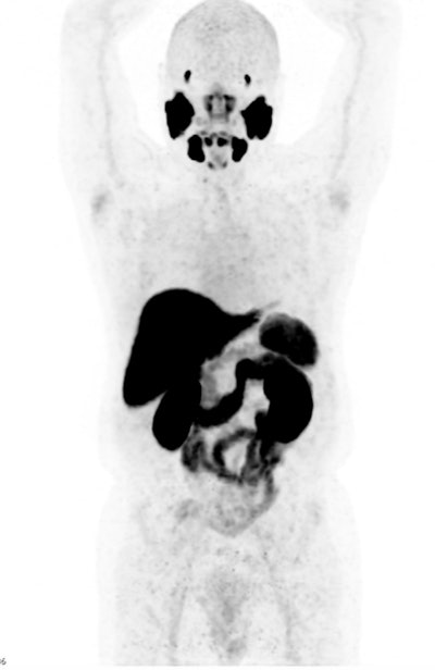 F-18 PSMA PET-CT proves clinical value in prostate cancer ...