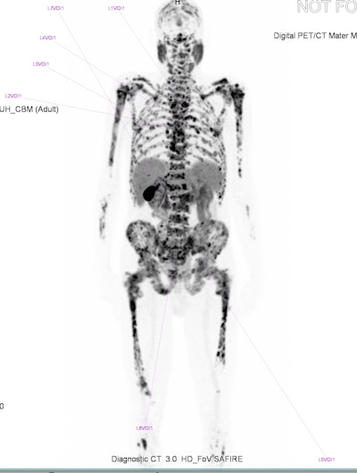 'Superscan' appearance for [F-18]-PSMA-1007.