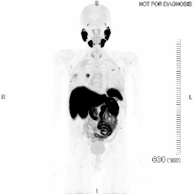 The first F-18-PSMA-1007 PET study was performed at the Mater in April 2022. The patient had been diagnosed with prostate cancer more than a decade earlier, having multiple nodal, lung, and bone metastases. Despite ongoing treatment with gonadotrophin-releasing hormone agonists, his prostate-specific antigen (PSA) was continually rising.