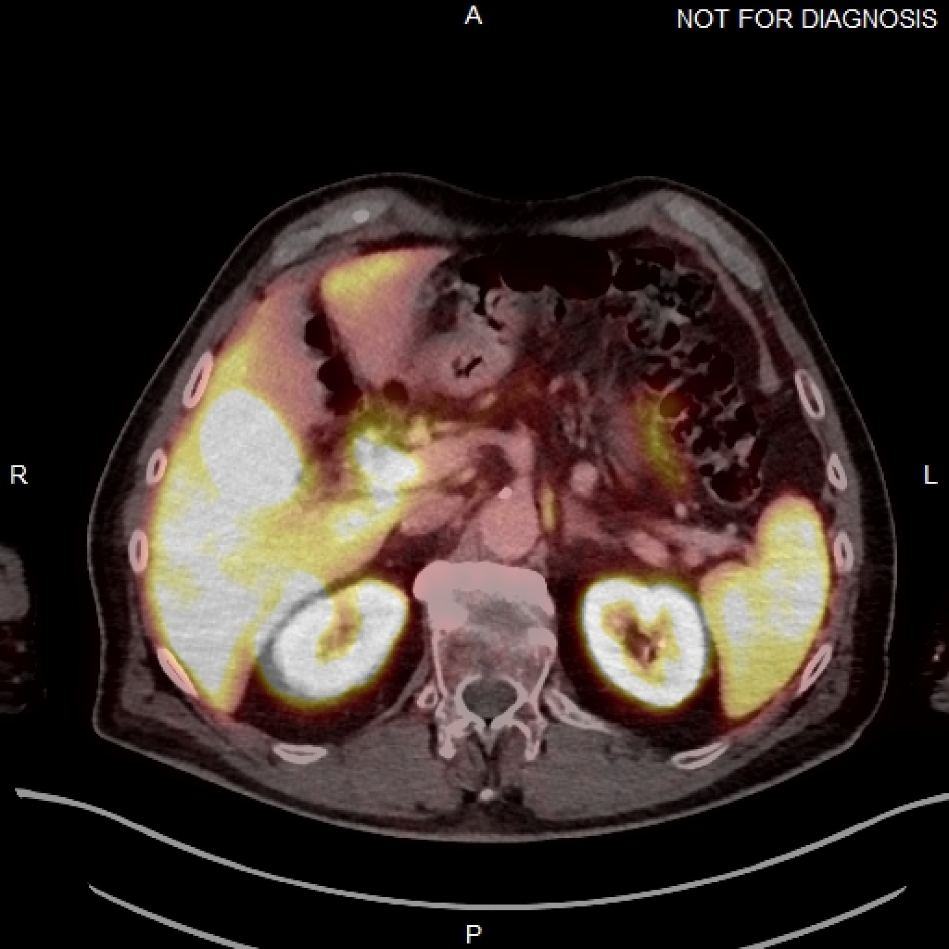 (Above) Fused axial image demonstrates uptake in the celiac ganglia. (Below) Corresponding CT scan. The celiac ganglia are visible. All figures courtesy of Dr. Jonathan Hunter, Dr. Jane Burns, and Prof. Martin O&rsquo;Connell and presented at ECR 2025.