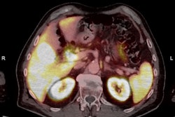 (Above) Fused axial image demonstrates uptake in the celiac ganglia. (Below) Corresponding CT scan. The celiac ganglia are visible. All figures courtesy of Dr. Jonathan Hunter, Dr. Jane Burns, and Prof. Martin O’Connell and presented at ECR 2025.