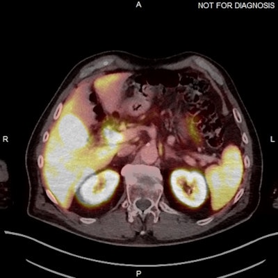 (Above) Fused axial image demonstrates uptake in the celiac ganglia. (Below) Corresponding CT scan. The celiac ganglia are visible. All figures courtesy of Dr. Jonathan Hunter, Dr. Jane Burns, and Prof. Martin O’Connell and presented at ECR 2025.