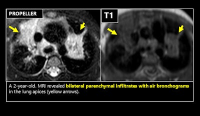 Techniques such as undersampling k-space or employing specialized k-space sampling strategies, including periodically rotated overlapping parallel lines with enhanced reconstruction (PROPELLER or BLADE), are effective in minimizing respiratory motion artifacts and improving image quality in challenging cases. Figures courtesy of Dr. Emre Ruhat Avci et al and presented at ECR 2025.