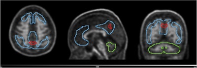 Volume with higher baseline signal for N1 accumulators and N1 non-accumulators of amyloid (red line) overlayed on the scan of an N1 accumulator (MNI space). Grey scale shows SUVR range. Blue line shows the Centiloid target region and the green line shows the reference region (whole cerebellum). Image and caption available for republishing under Creative Commons license (CC BY 4.0 DEED, Attribution 4.0 International) and courtesy of the European Journal of Nuclear Medicine and Molecular Imaging.
