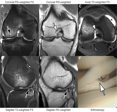 MRI scans in an 18-year-old man with right knee pain following a noncontact twisting injury playing basketball. Combined threefold parallel imaging (PIx3) and twofold simultaneous multislice (SMSx2) accelerated deep learning super-resolution turbo spin-echo sequences (A-E) were acquired at 3 tesla. Coronal proton density (PD) fat-suppressed (FS) (A), coronal PD-weighted (B), axial T2-weighted fat-suppressed (C), sagittal T2-weighted fat-suppressed (D), and sagittal PD-weighted (E) MRI scans demonstrate findings suggestive of a pivot-shift mechanism injury with a transchondral fracture of the central lateral femoral condyle (arrow in A) and transchondral bone contusion of the posterolateral tibial plateau, a femoral attachment full-thickness tear of the anterior cruciate ligament (arrows in B and C), joint effusion (asterisk in C), and a nondisplaced vertical-longitudinal tear along the posterior segment of the lateral meniscus (arrows in D and E). Readers correctly diagnosed the findings. An arthroscopic knee surgery photograph (F) demonstrates the lateral meniscus tear (arrow in F). FS = fat-suppressed. PD = proton density. Images and caption courtesy of the AJR.