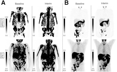 Patient examples of SPECT/CT and PET/CT RECIP 1.0. (A) SPECT and PET maximum-intensity projection (MIP) images in 74-year-old man with mCRPC. Serum PSA level at baseline was 449 ng/mL and slightly increased to 525 ng/mL after two cycles of Lu-177 PSMA. Eastern Cooperative Oncology Group (ECOG) score was 2 at baseline and increased to 3 after 2 cycles. The patient was classified by readers as RECIP-progressive disease on both SPECT and PET. Overall survival was 4.7 months. Two cycles of Lu-177 PSMA were administered. (B) SPECT and PET MIP images in 74-year-old man with mCRPC. Serum PSA level was 231 ng/mL at baseline and decreased to 12.5 ng/mL after 2 cycles of Lu-177 PSMA. ECOG score was less than 2 at baseline and after 2 cycles of Lu-177 PSMA. The patient was classified by readers as RECIP-partial response on both SPECT and PET. Overall survival was 14.3 months. Four cycles of Lu-177 PSMA were administered.