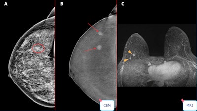 Case of a multicentric Luminal A invasive ductal carcinoma. While conventional mammography would have detected one lesion, contrast-enhanced mammography detected multicentricity, and this was confirmed by MRI. All figures courtesy of Drs. Manuel R López de la Torre Carretero, Miguel Barrio Piqueras, and Luis Javier Pina Insausti and presented at ECR 2025.