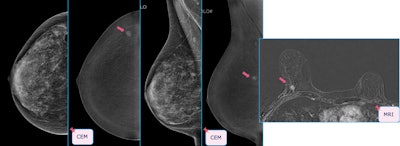 Case of a unifocal Luminal B invasive ductal carcinoma. Contrast-enhanced mammography shows better accuracy than conventional techniques in detecting these lesions, and this was confirmed by MRI study.