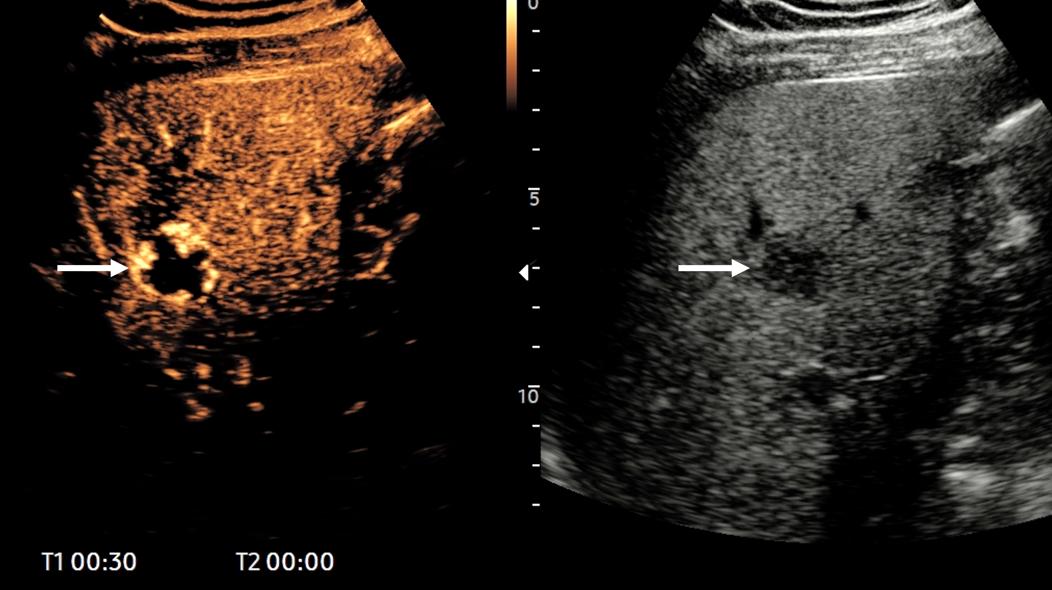 In a 47-year-old man with upper abdominal pain, ultrasound shows a fatty liver and an atypical lesion (arrow). The CEUS examination answered the question in 30 seconds -- this is a hemangioma, with classical pathognomonic peripheral globular enhancement (arrow). It&rsquo;s a &ldquo;slam-dunk&rdquo; diagnosis: no further imaging, no further costs, and the patient knows immediately that this is benign. Figure courtesy of Prof. Paul Sidhu.
