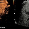 In a 47-year-old man with upper abdominal pain, ultrasound shows a fatty liver and an atypical lesion (arrow). The CEUS examination answered the question in 30 seconds -- this is a hemangioma, with classical pathognomonic peripheral globular enhancement (arrow). It’s a “slam-dunk” diagnosis: no further imaging, no further costs, and the patient knows immediately that this is benign. Figure courtesy of Prof. Paul Sidhu.