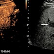 In a 47-year-old man with upper abdominal pain, ultrasound shows a fatty liver and an atypical lesion (arrow). The CEUS examination answered the question in 30 seconds -- this is a hemangioma, with classical pathognomonic peripheral globular enhancement (arrow). It’s a “slam-dunk” diagnosis: no further imaging, no further costs, and the patient knows immediately that this is benign. Figure courtesy of Prof. Paul Sidhu.