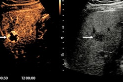 In a 47-year-old man with upper abdominal pain, ultrasound shows a fatty liver and an atypical lesion (arrow). The CEUS examination answered the question in 30 seconds -- this is a hemangioma, with classical pathognomonic peripheral globular enhancement (arrow). It’s a “slam-dunk” diagnosis: no further imaging, no further costs, and the patient knows immediately that this is benign. Figure courtesy of Prof. Paul Sidhu.