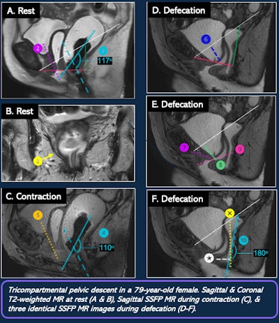 MR defecography exam on a 79-year-old woman.