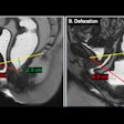 2025 05 26 Pelvic Floor Fig 3 Thumbnail