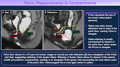 Applications of the H-line and M-line. All figures courtesy of Dr. Nitin Venugopal et al, Department of Radiology, University of Washington, and presented at ECR 2025.