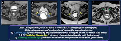 Signs of endopelvic fascial defects on MR defecography.