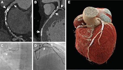 Images in a 62-year-old male patient with a history of anteroseptal infarction, treated with percutaneous coronary intervention with stent placement in the left anterior descending artery (LAD) and right coronary artery (RCA), who presented with recurrent typical angina. The patient was scanned with a NAEOTOM Alpha photon-counting detector (PCD) CT system with contrast enhancement and an average heart rate of 57 beats per minute (140 kV, 0.2-mm section thickness, Bv56 kernel, iterative reconstruction strength of 4). (A) Multiplanar reformation image: The stent in the proximal RCA was occluded (lower arrow). The upper arrow indicates a significant stenosis. (B) Multiplanar reformation: Stent in the distal LAD appears patent (lower arrow), but a nonsignificant hypoattenuating region in the mid LAD was observed with PCD CT (middle arrow). Additionally, calcifications were observed at the origin of the first diagonal with a significant stenosis (upper arrow). (C) Invasive coronary angiographic image of the RCA helps confirm results found at PCD CT. The arrow indicates the occlusion of the RCA. (D) Invasive coronary angiographic image of the LAD helps confirm results found at PCD CT. Left arrow shows the nonsignificant stenosis in the mid LAD while the right arrow indicates the significant stenosis in the first diagonal. (E) Volume-rendered image of the heart. Images and caption courtesy of the RSNA.