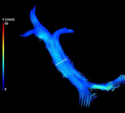 Velocity streamlines of the portal vein measured using 4D flow MRI in a cirrhosis patient (a 62-year-old male), shown at the cardiac cycle time t = 84 ms. A cut-plane (white marker) matching the 2D flow image plane was used to quantify the 4D flow parameters in the main portal vein.