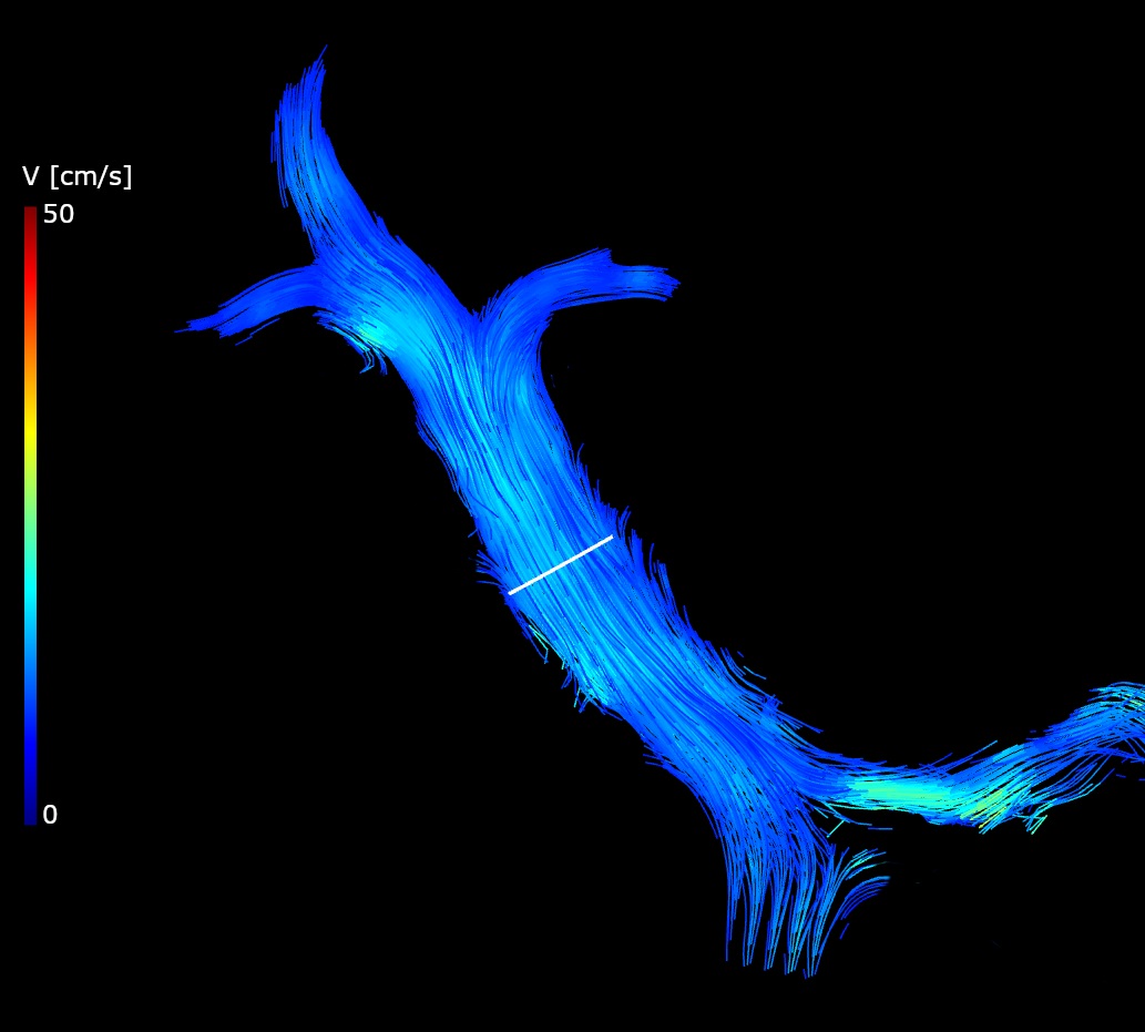 4d Flow Mri Portal Vein oz Gnp Np620