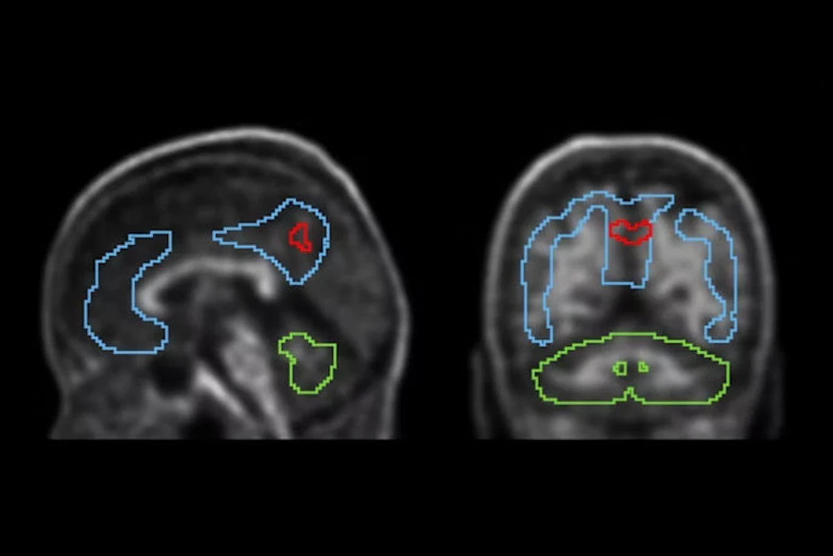 Study Reveals PET Scans Predict Alzheimer's Risk Early