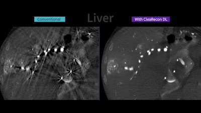 Images compare CBCT liver images with and without the CleaRecon DL system.