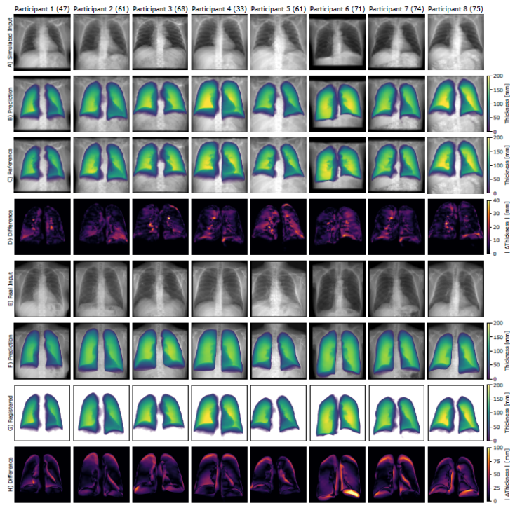 Frontal Chest Radiographs 101148 Ryai240484 m Cnnc B Bfx I