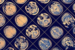 Mri Brain