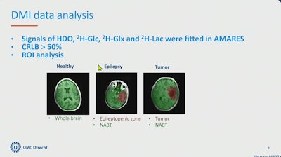A research team out of University Medical Center Utrecht in the Netherlands described their DMI metabolic modeling approach at ISMRM 2025. It found differences in brain tissue between healthy, epilepsy, and brain tumor patients.