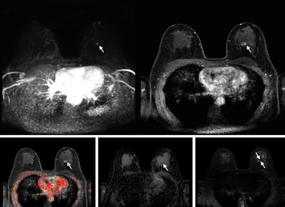 Abbreviated axial MRI images show a 7-mm irregular mass with irregular margin (arrows) in the right upper inner quadrant with early rapid enhancement (BIRADS 4). The participant was recalled and underwent an MRI-guided vacuum-assisted biopsy that showed sclerosing adenosis with microcalcifications and usual ductal hyperplasia and focal apocrine metaplasia. On the full-protocol images (not shown), the lesion was T2-weighted hypointense and showed diffusion restriction and washout kinetics in the delayed phase, characteristics that would not have reversed the decision to recall the participant.