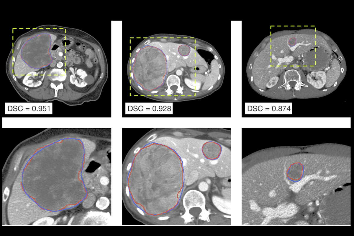 Barcelona radiomics team reveals AI progress in liver cancer Barcelona radiomics team reveals AI progress in liver cancer