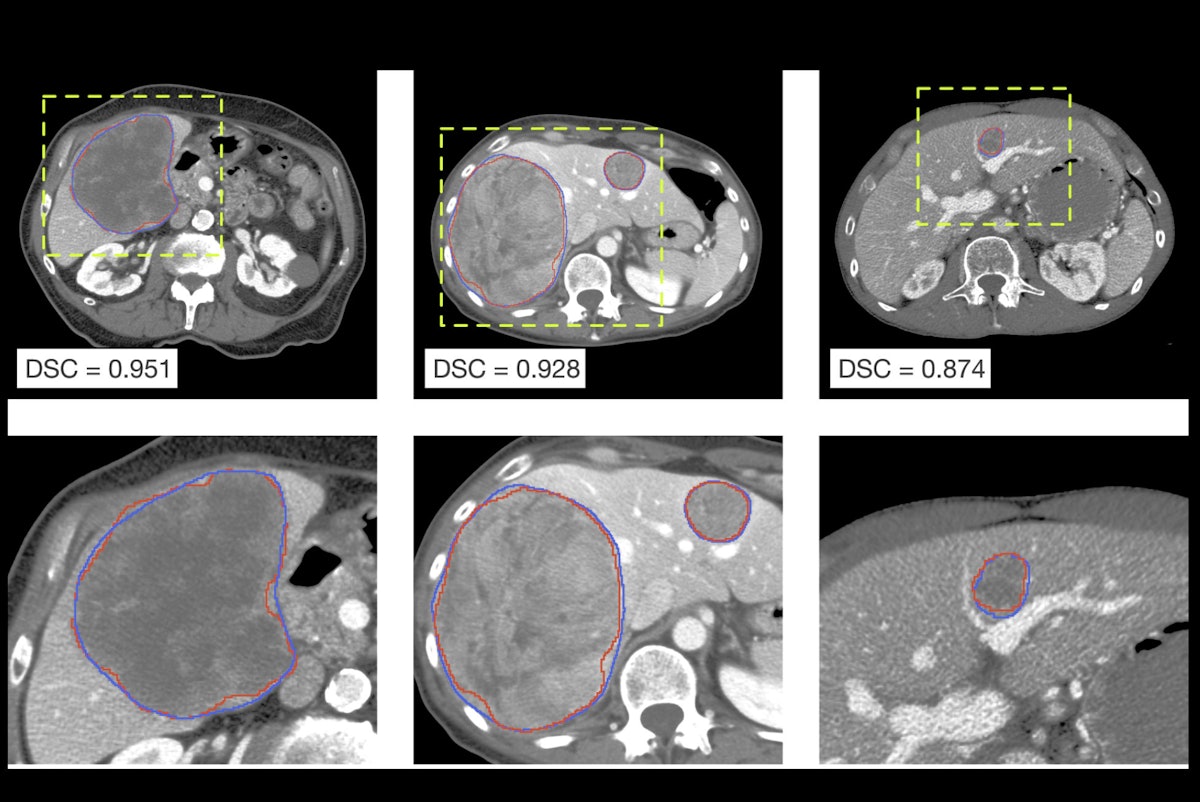Barcelona radiomics team reveals AI progress in liver cancer