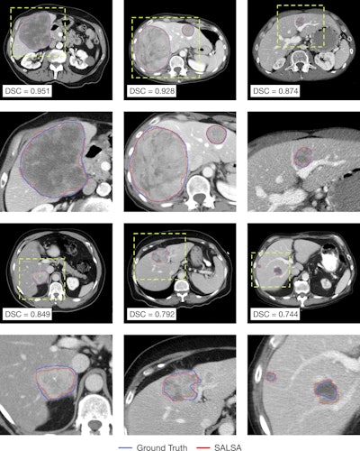Visual inspection of the automatically delineated contours. Representative cases of liver tumors delineated by SALSA (red) alongside the ground truth (blue) segmented masks. Yellow-dashed boxes indicate the magnification done for better visualization. Image courtesy of Maria Balaguer-Montero, Dr. Raquel Perez-Lopez et al and presented at ECR 2025.