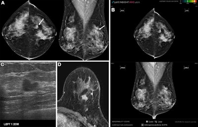 Images in a 42-year-old asymptomatic woman. (A) Digital mammograms show an irregular spiculated mass in the left upper outer quadrant (arrows). (B) Artificial intelligence (AI) software did not mark this lesion due to a low abnormality score. (C) Ultrasound and (D) breast MRI scans revealed a 1.1-cm irregular mass in the left upper outer breast at the 1-o'clock position. Breast-conserving surgery was performed; the lesion was confirmed as a 1.1-cm invasive ductal carcinoma (luminal subtype, histologic grade 3) without axillary lymph node metastasis. The lesion was classified as actionable; three radiologists categorized it as suspicious. The reason for the AI miss was that the lesion was obscured by overlying dense breast tissue. CC = craniocaudal, MLO = mediolateral. Images and caption courtesy of the RSNA.