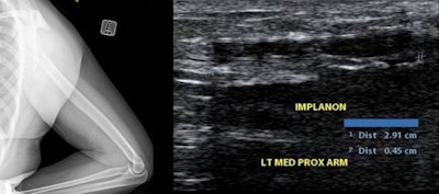 Left: Lateral radiograph of patient with a known dermal contraceptive implant. Right: Ultrasound image in the same patient.